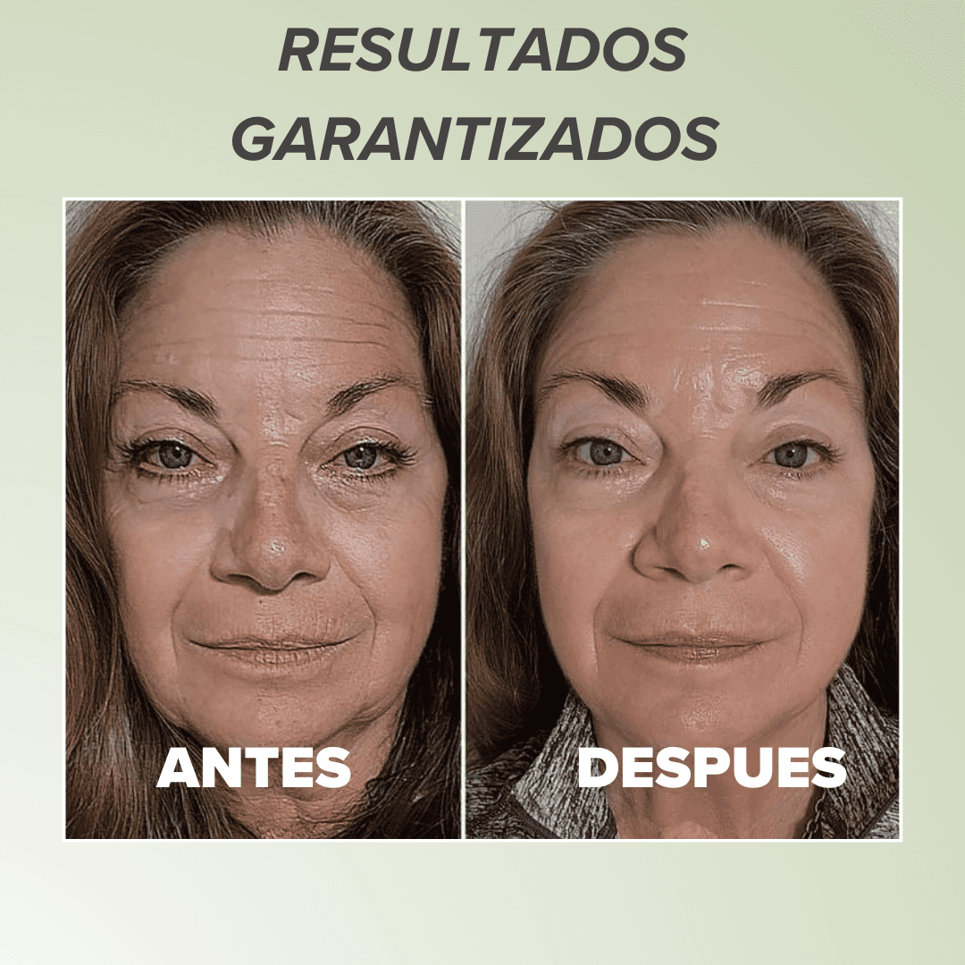 Espatula Ultrasonica Elimina Puntos Negros y Acné - ULTRASKIN