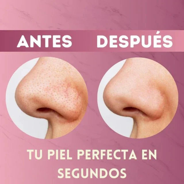 Extractor de puntos negros - Manten tu piel radiante
