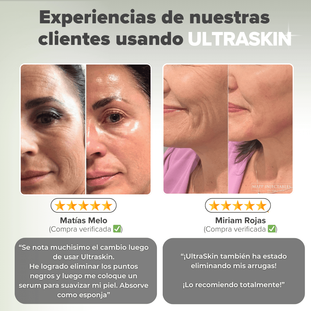 Espatula Ultrasonica Elimina Puntos Negros y Acné - ULTRASKIN